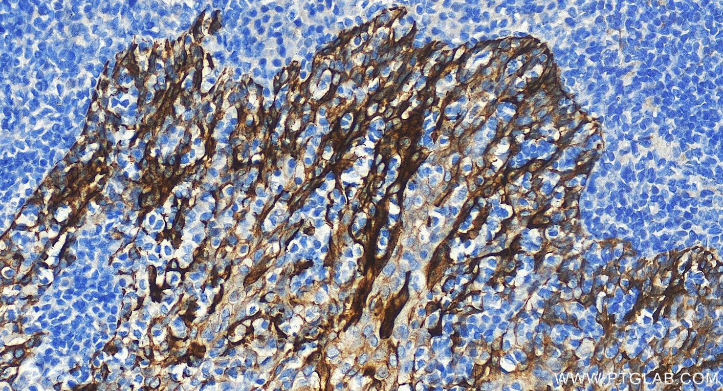 IHC staining of human tonsillitis using 10384-1-AP