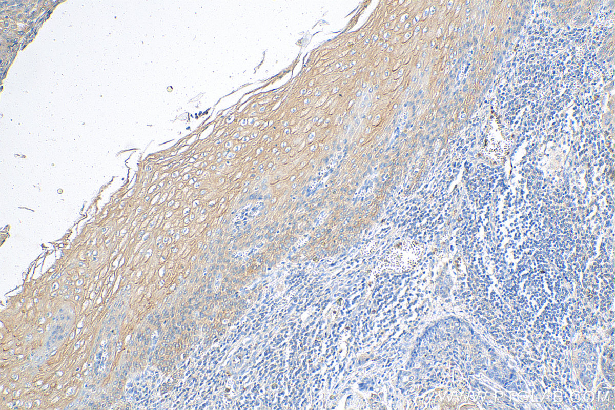IHC staining of human oesophagus cancer using Biotin-16835