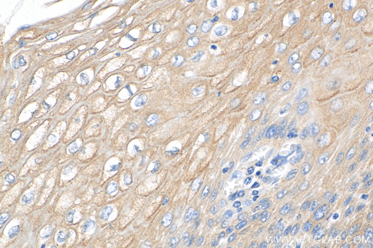 IHC staining of human oesophagus cancer using Biotin-16835