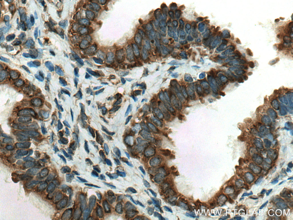 IHC staining of human ovary tumor using 19841-1-AP