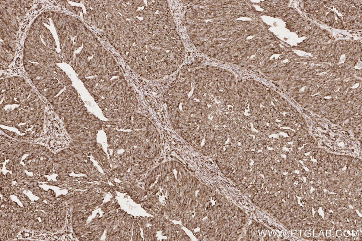 IHC staining of human ovary cancer using 19841-1-AP