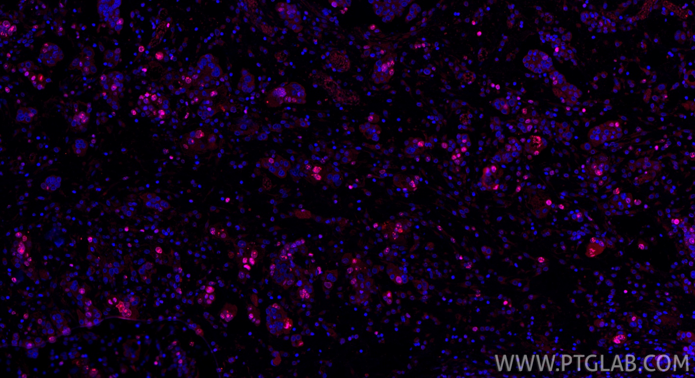IF Staining of human ovary cancer using 66555-6-Ig (same clone as 66555-6-PBS)