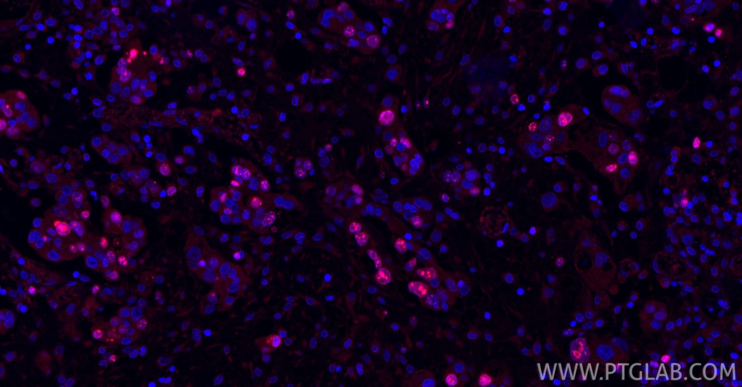 IF Staining of human ovary cancer using 66555-6-Ig (same clone as 66555-6-PBS)