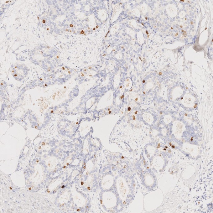 IHC staining of human breast cancer using 66555-6-Ig