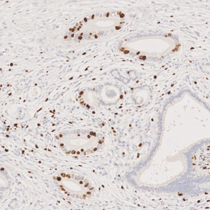 IHC staining of Cholangiocarcinoma using 66555-6-Ig