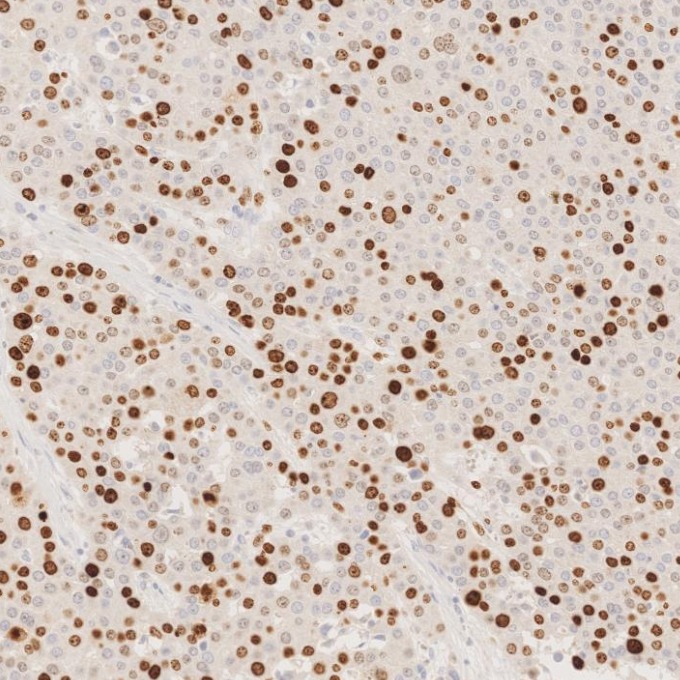 IHC staining of human liver cancer using 66555-6-Ig
