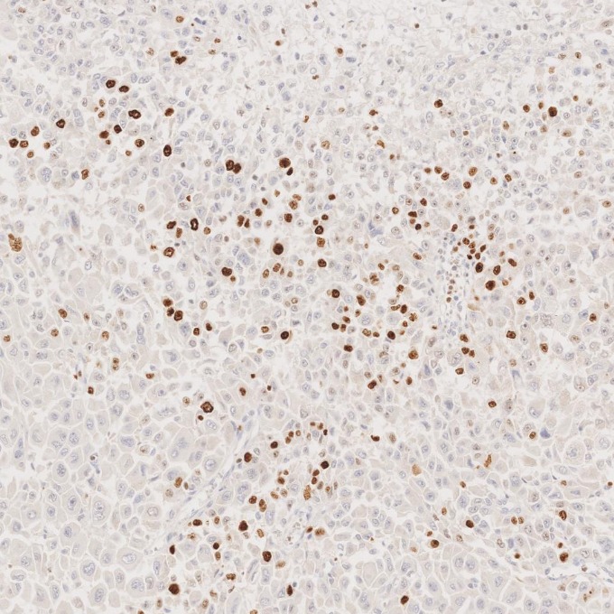 IHC staining of human stomach cancer using 66555-6-Ig