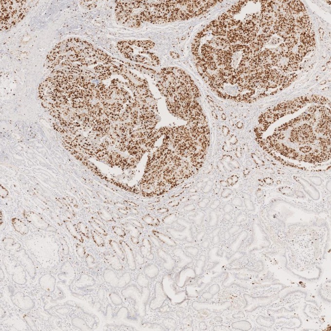 IHC staining of human stomach cancer using 66555-6-Ig