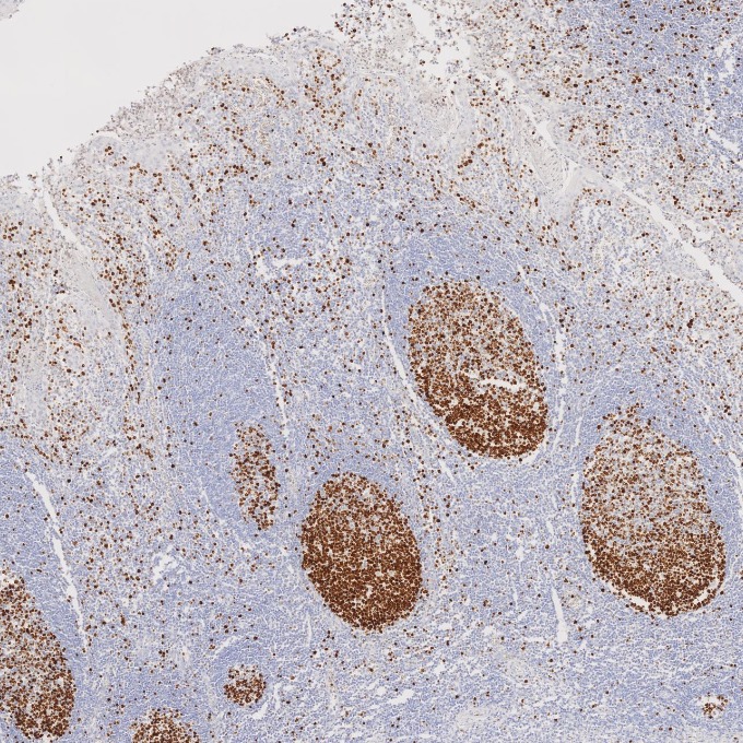 IHC staining of human tonsillitis using 66555-6-Ig