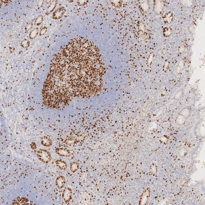 IHC staining of human appendicitis using 66555-6-Ig