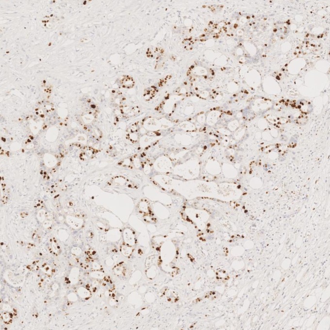 IHC staining of human pancreas cancer using 66555-6-Ig