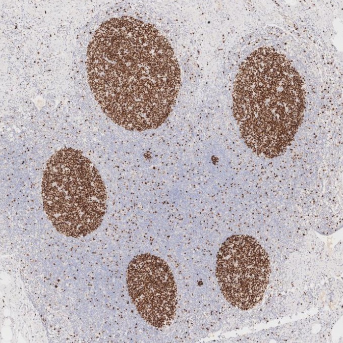 IHC staining of human appendicitis using 66555-6-Ig