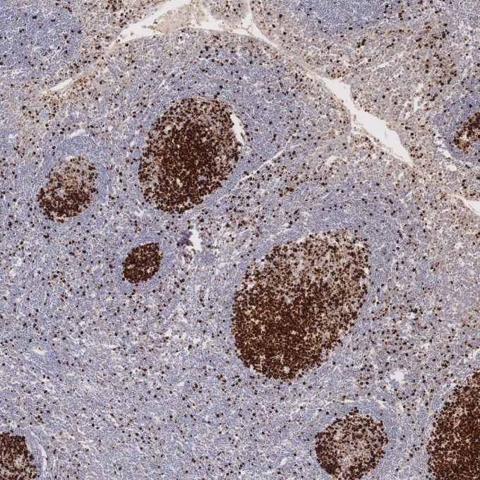 IHC staining of human tonsillitis using 66555-6-Ig