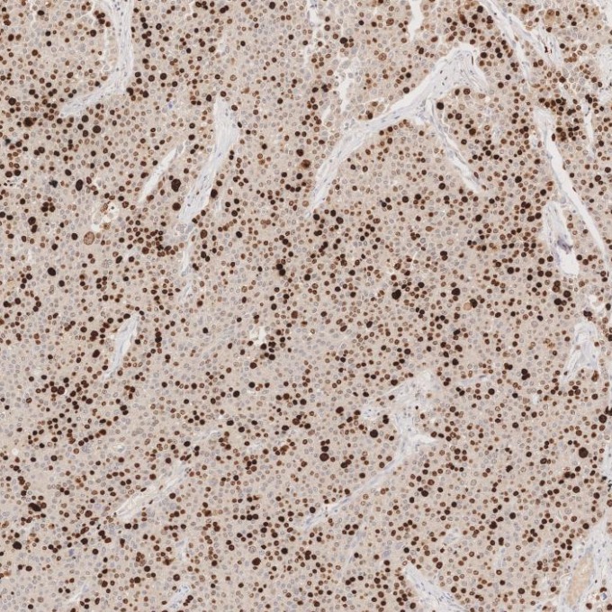 IHC staining of human liver cancer using 66555-6-Ig