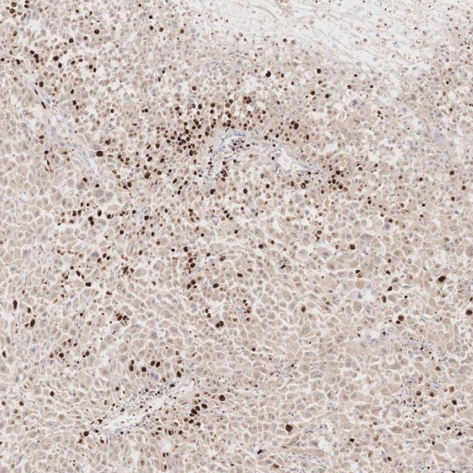 IHC staining of human stomach cancer using 66555-6-Ig
