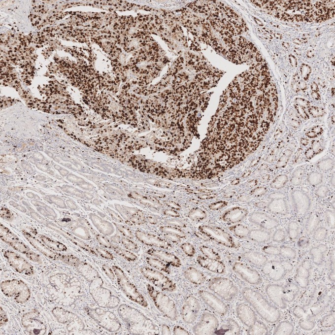 IHC staining of human stomach cancer using 66555-6-Ig