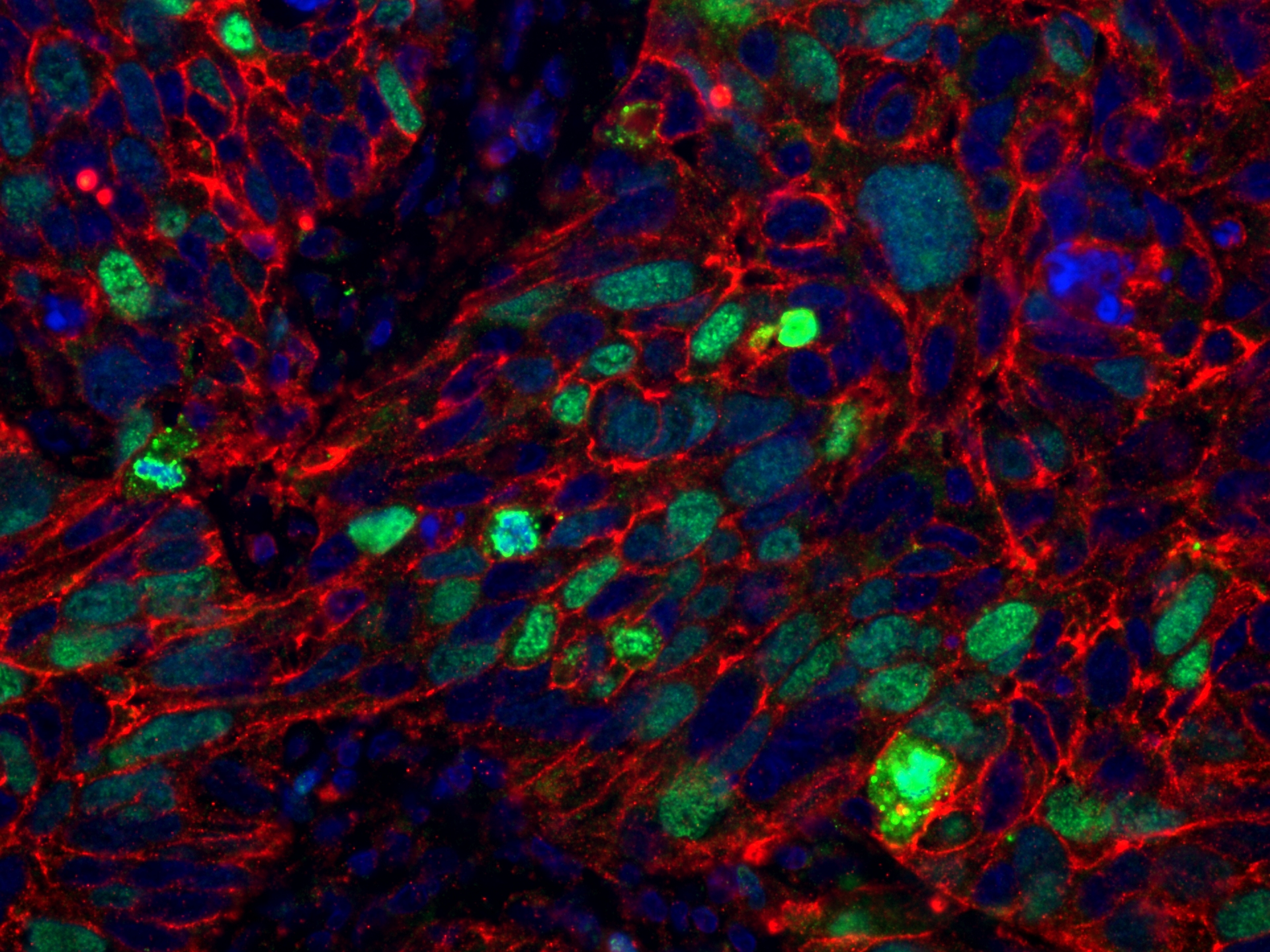IF Staining of human lung cancer using 84192-4-RR (same clone as 84192-4-PBS)