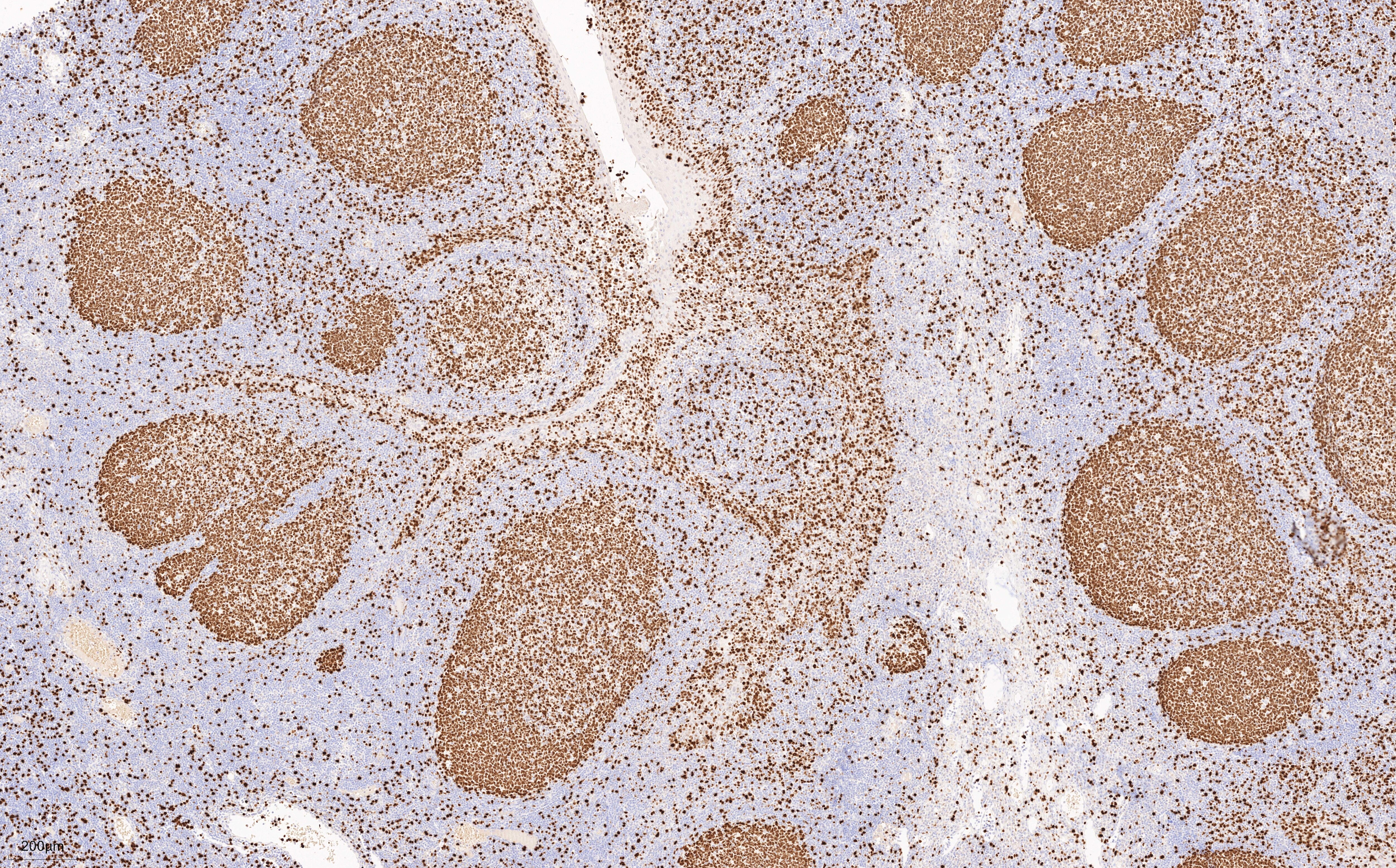 IHC staining of human tonsillitis using 84192-4-RR