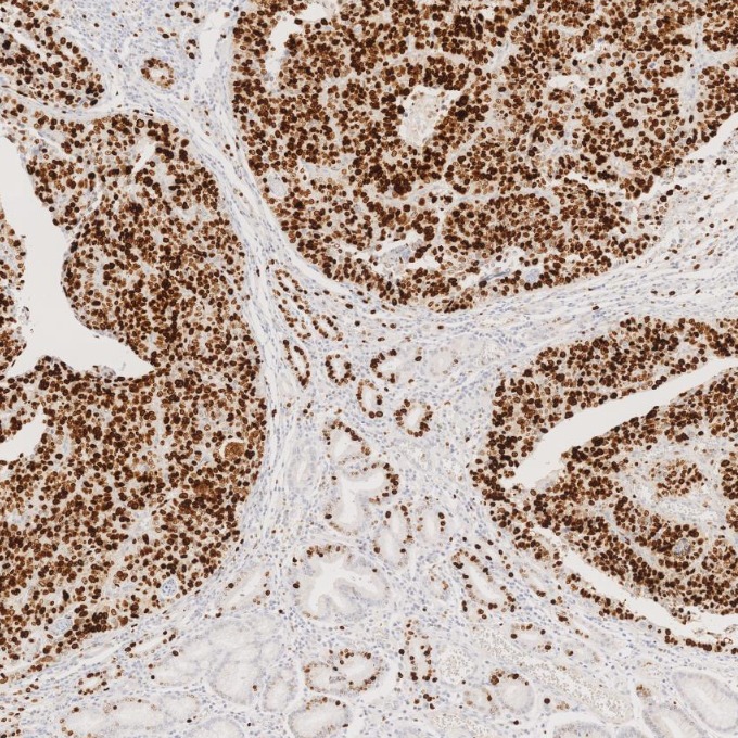 IHC staining of human stomach cancer using 84192-4-RR