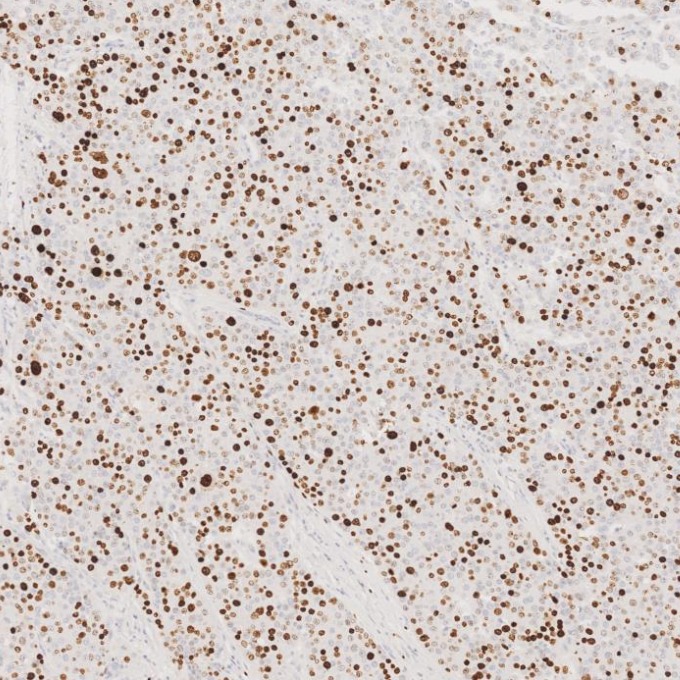 IHC staining of human liver cancer using 84192-4-RR