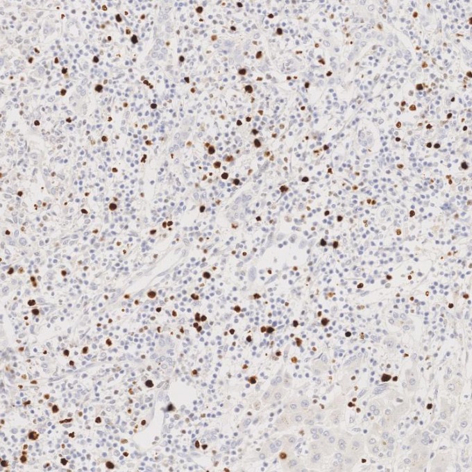 IHC staining of Cholangiocarcinoma using 84192-4-RR