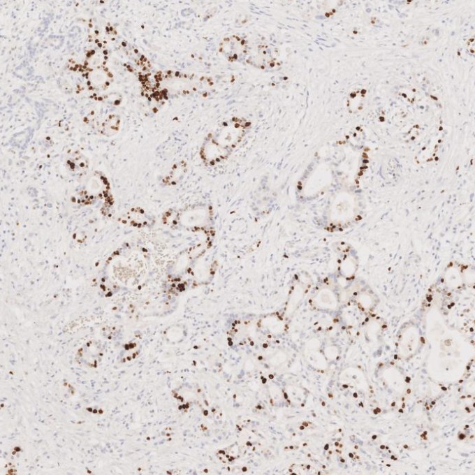 IHC staining of human pancreas cancer using 84192-4-RR