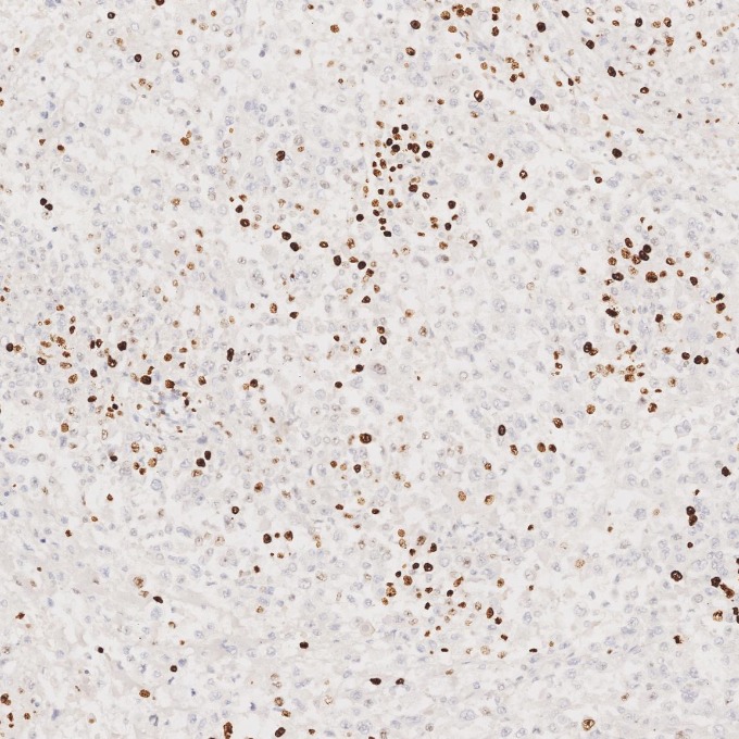 IHC staining of human stomach cancer using 84192-4-RR