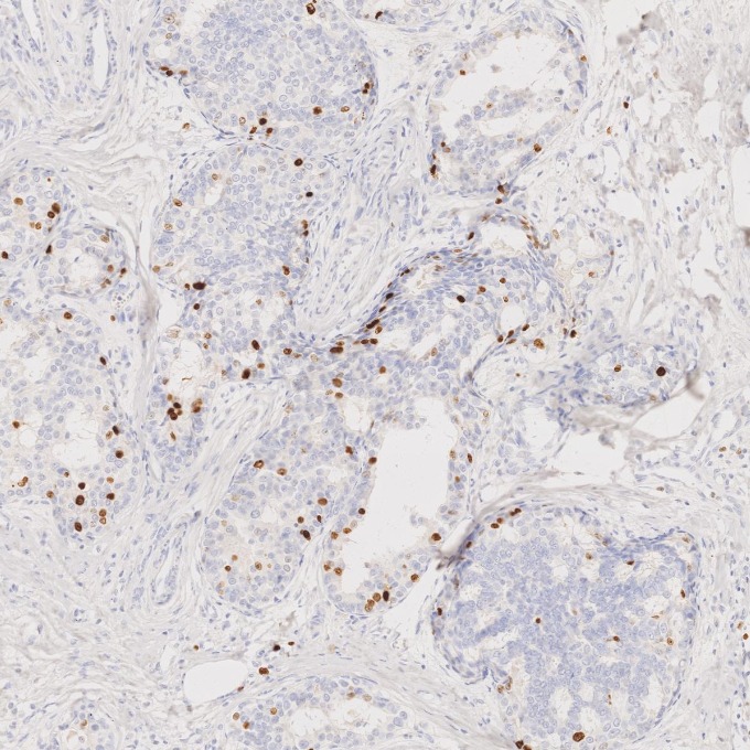 IHC staining of human breast cancer using 84192-4-RR