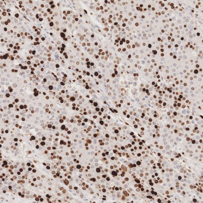 IHC staining of human liver cancer using 84192-4-RR