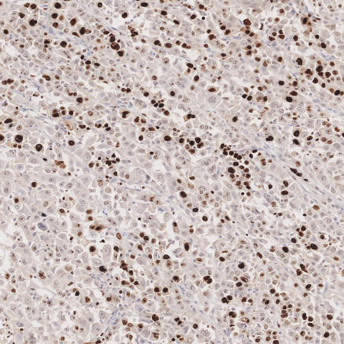 IHC staining of human stomach cancer using 84192-4-RR