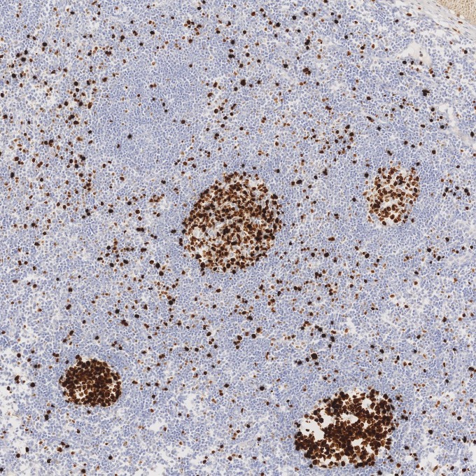 IHC staining of human tonsillitis using 84192-4-RR