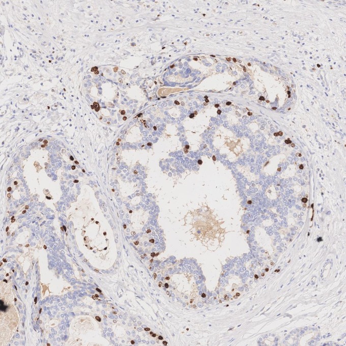 IHC staining of human breast cancer using 84192-4-RR