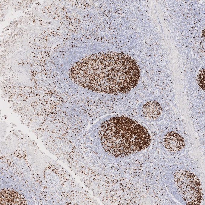 IHC staining of human tonsillitis using 84192-4-RR