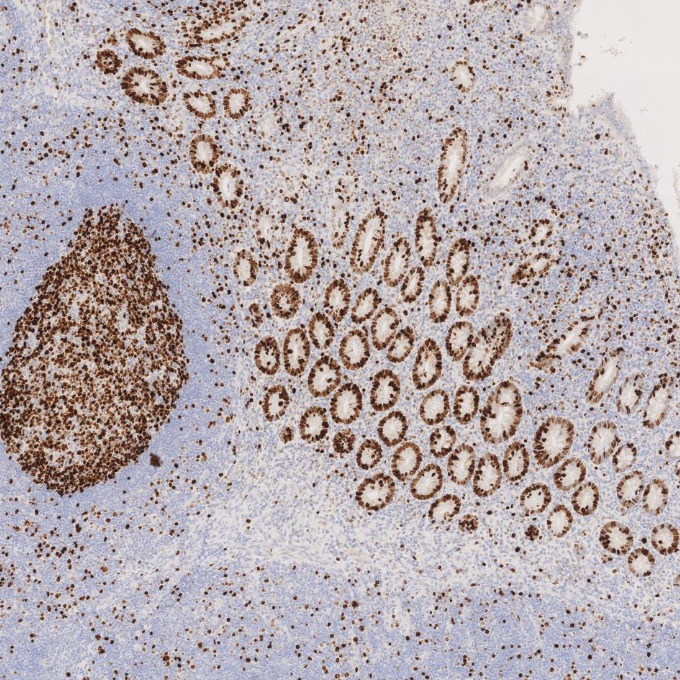 IHC staining of human appendicitis using 84192-4-RR