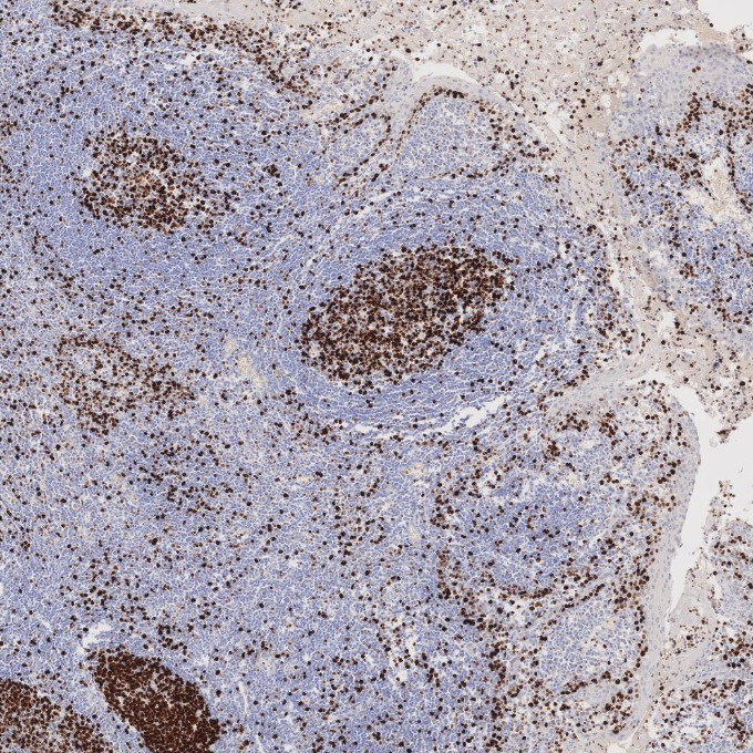 IHC staining of human tonsillitis using 84192-4-RR