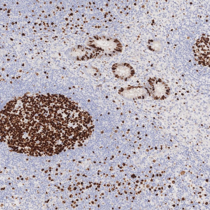 IHC staining of human appendicitis using 84192-4-RR