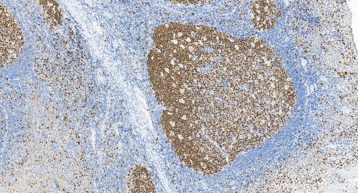 IHC staining of human tonsillitis using Biotin-84192-4