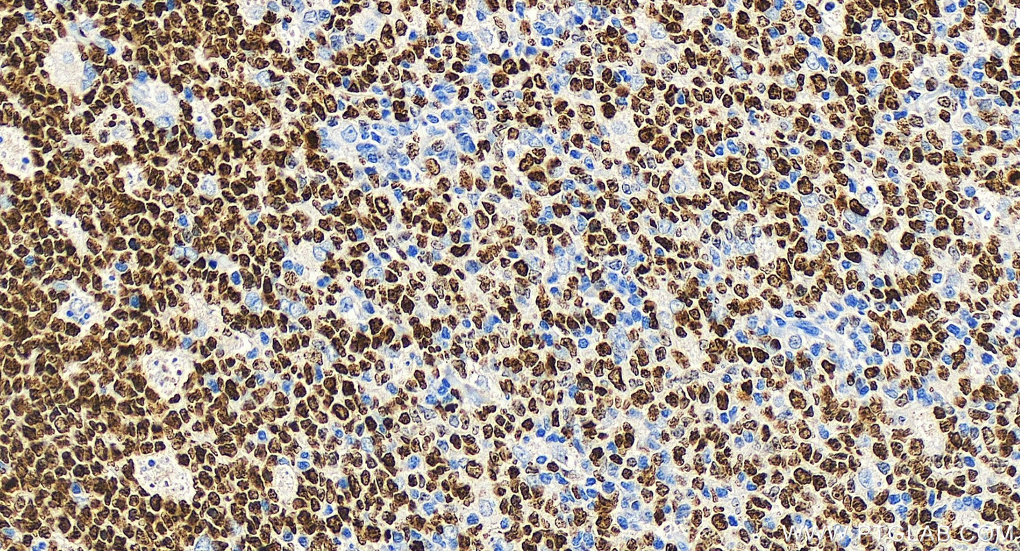 IHC staining of human tonsillitis using Biotin-84192-4