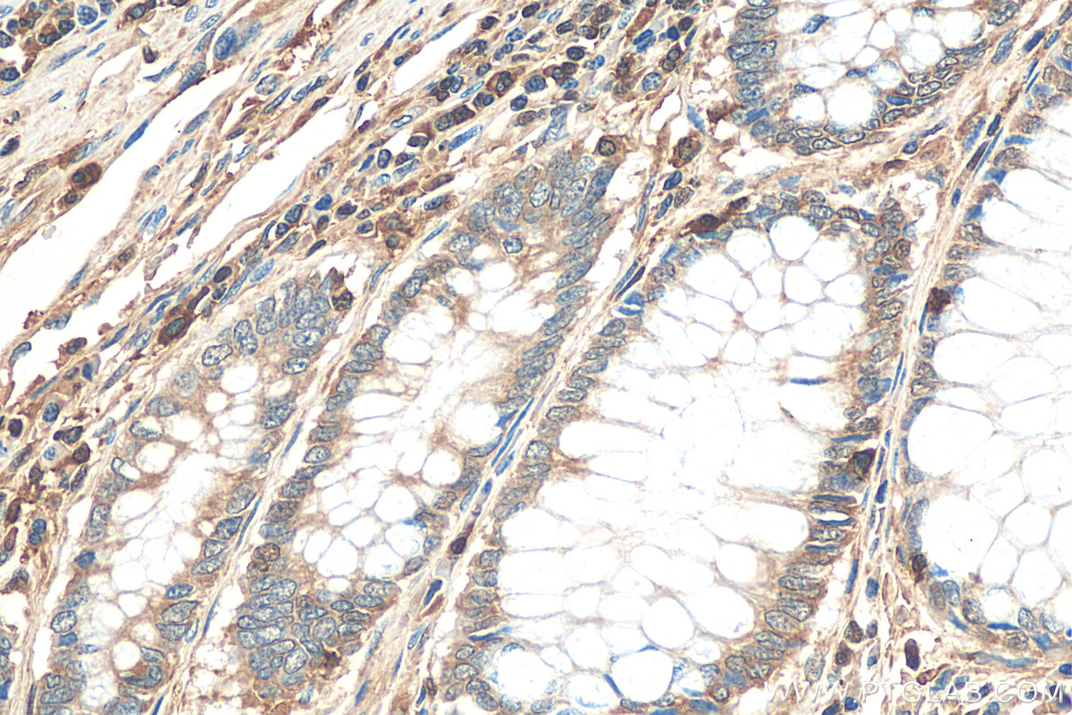 IHC staining of human colon cancer using 55208-1-AP