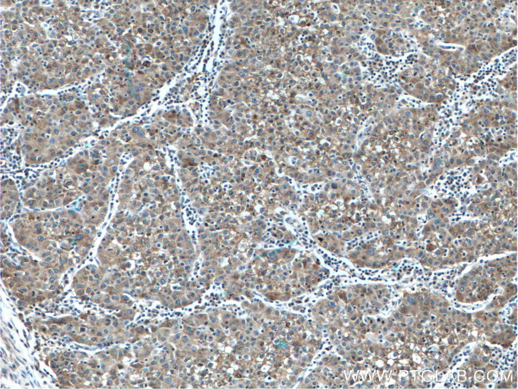 IHC staining of human liver cancer using 22341-1-AP