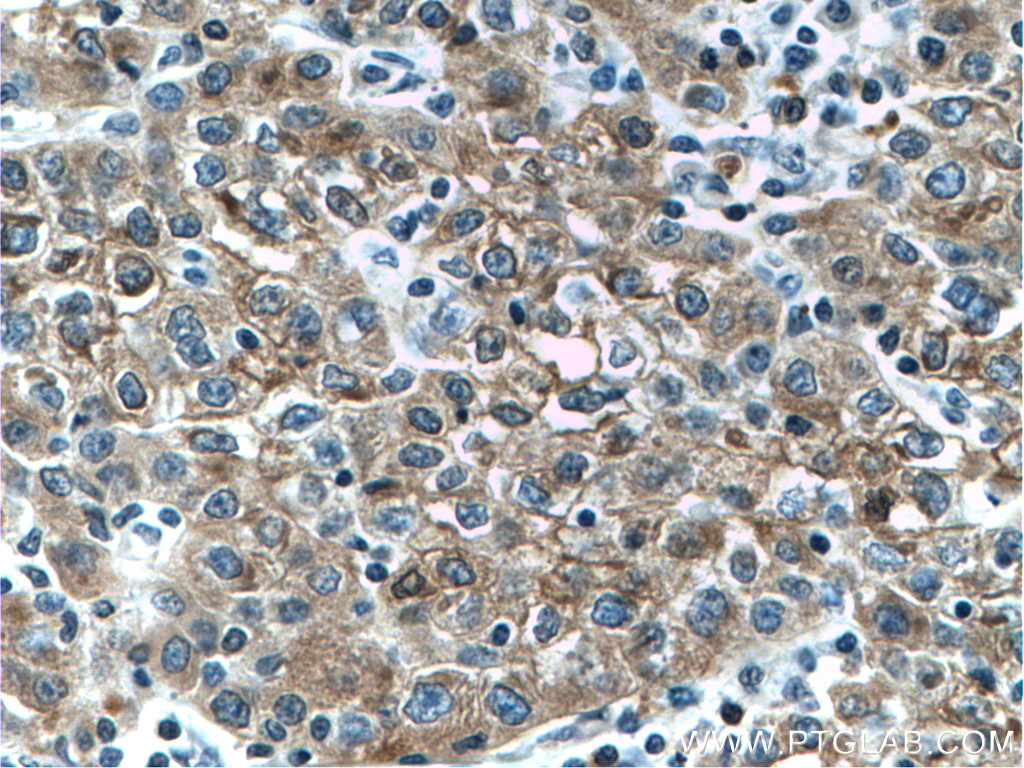 IHC staining of human liver cancer using 22341-1-AP