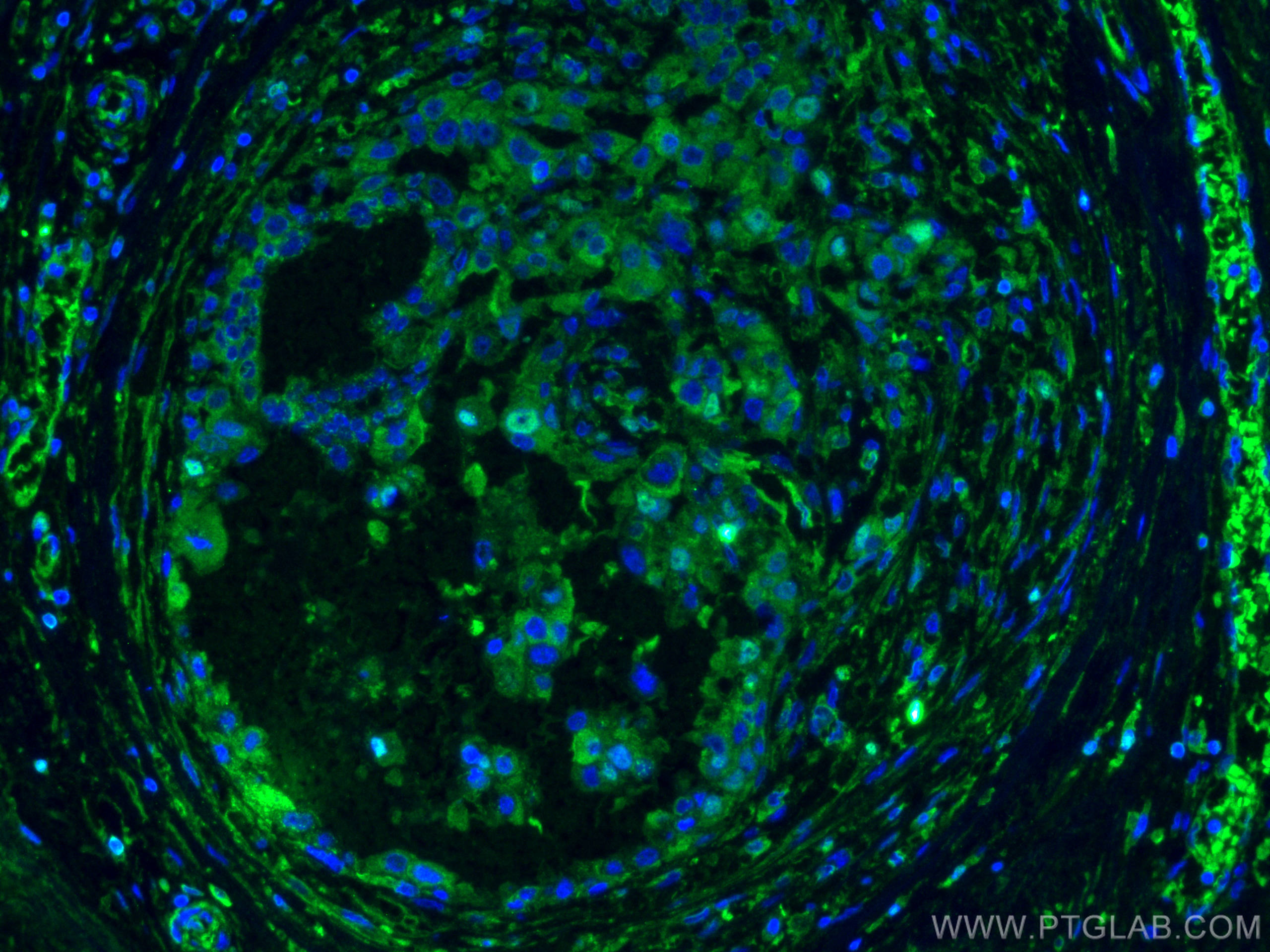 IF Staining of human breast cancer using 66269-1-Ig (same clone as 66269-1-PBS)