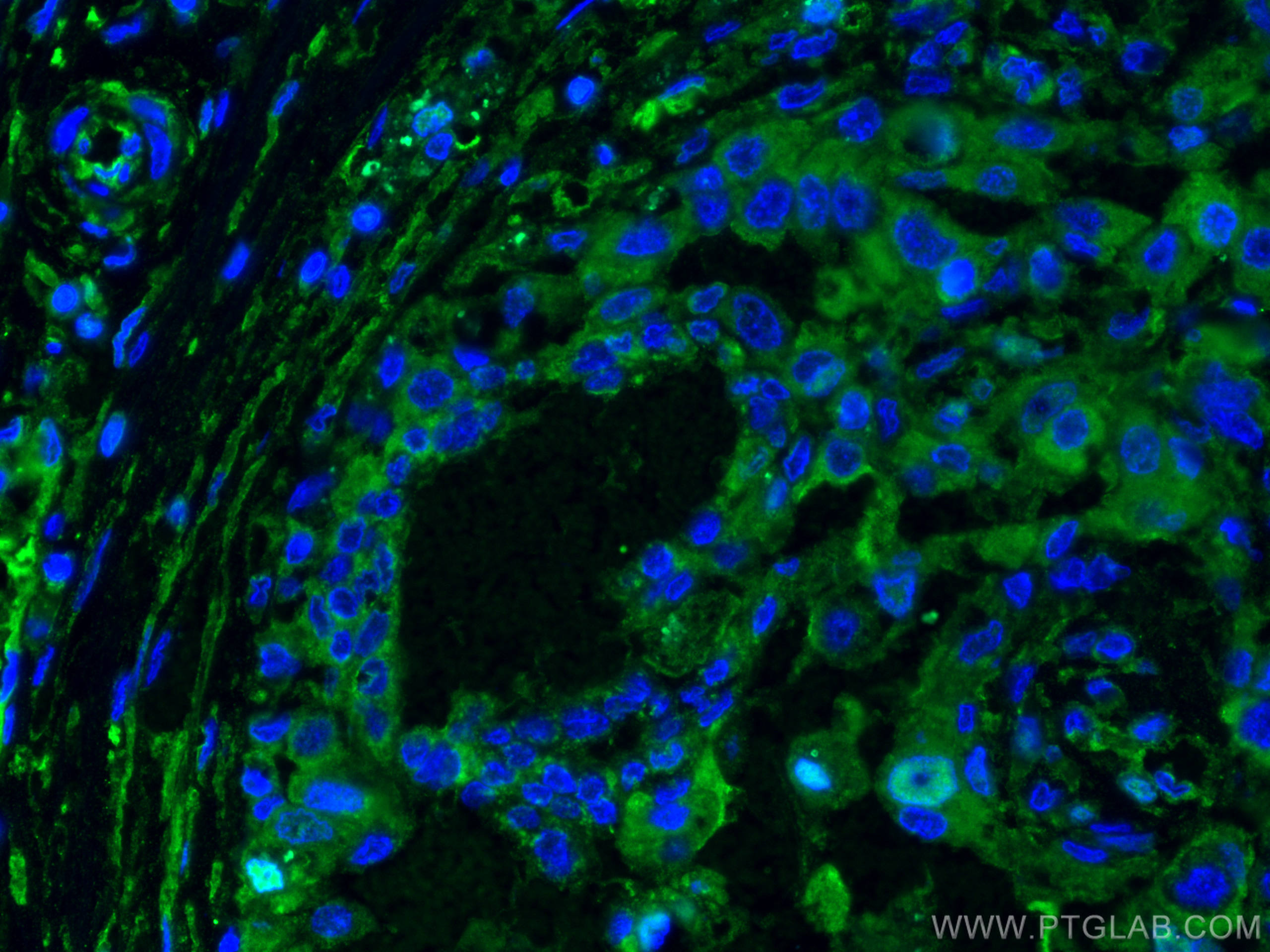 IF Staining of human breast cancer using 66269-1-Ig (same clone as 66269-1-PBS)
