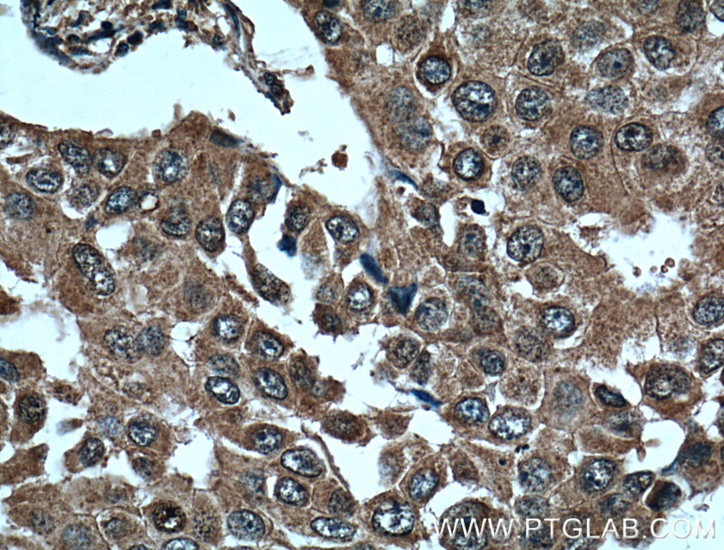 IHC staining of human breast cancer using 66269-1-Ig (same clone as 66269-1-PBS)