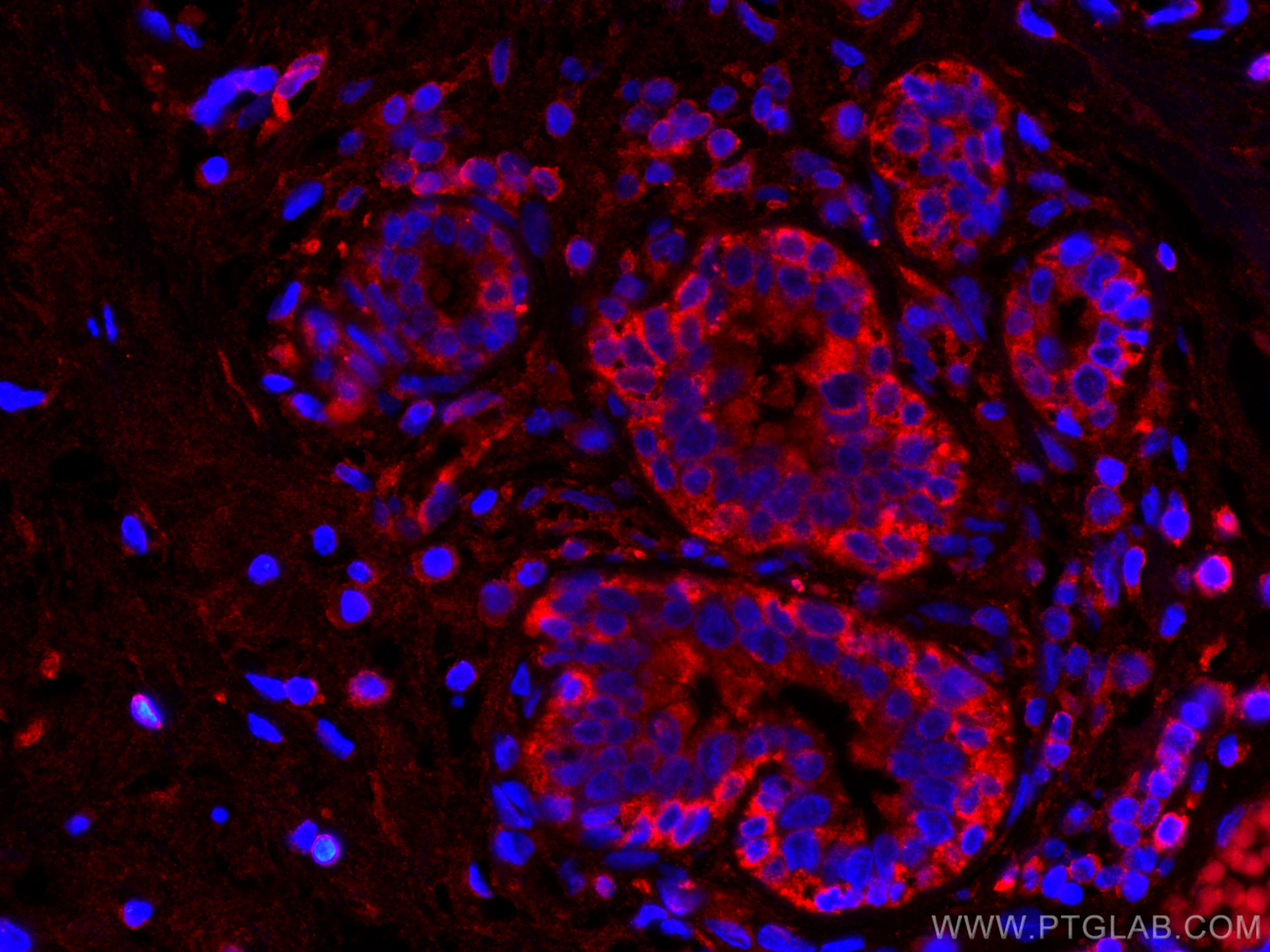 IF Staining of human breast cancer using CL594-66269