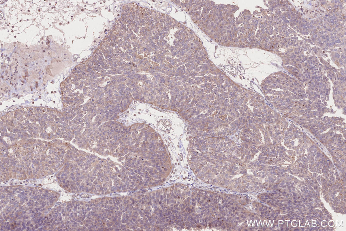 IHC staining of human ovary cancer using 27895-1-AP