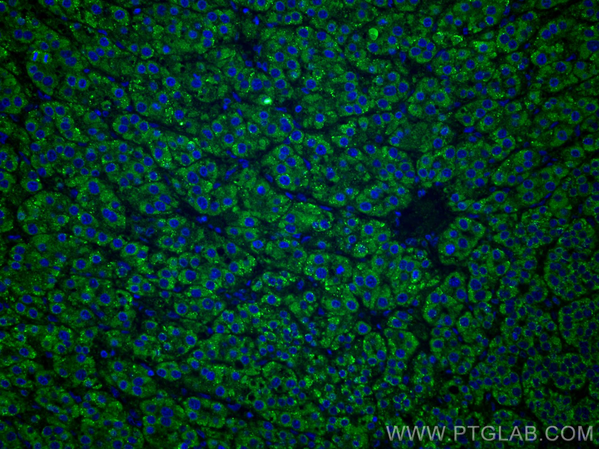 IF Staining of human liver cancer using 67399-1-Ig (same clone as 67399-1-PBS)