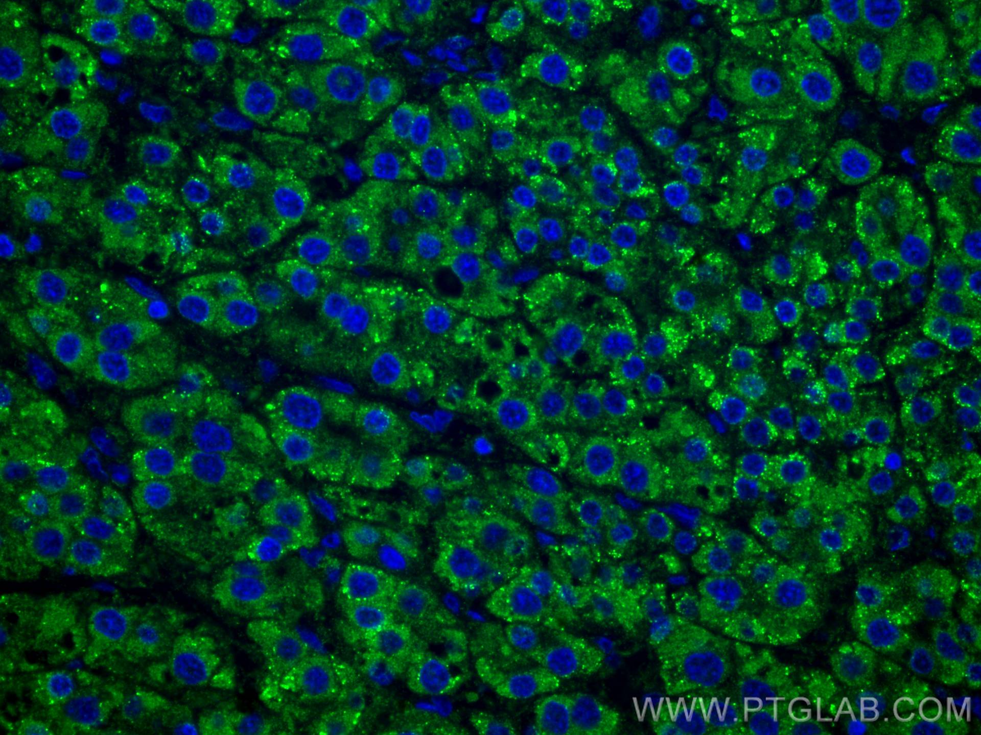 IF Staining of human liver cancer using 67399-1-Ig (same clone as 67399-1-PBS)