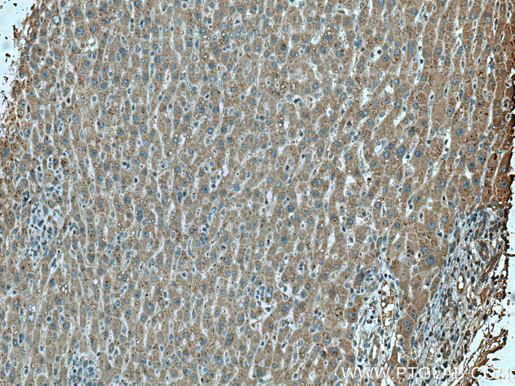 IHC staining of human liver cancer using 67399-1-Ig (same clone as 67399-1-PBS)