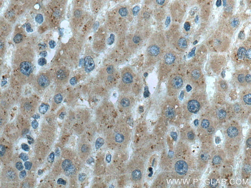 IHC staining of human liver cancer using 67399-1-Ig (same clone as 67399-1-PBS)